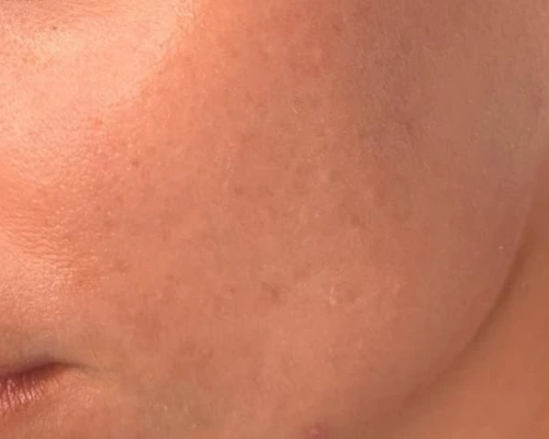 acne clear picture in 30 days challenge