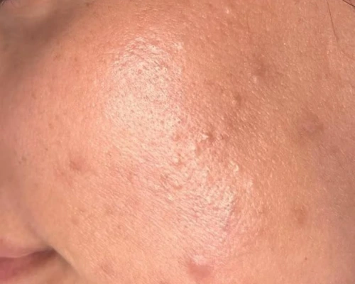 before acne on face picture